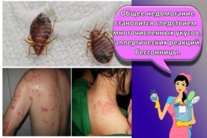 20 способов, как быстро избавиться от бельевых вшей в домашних условиях